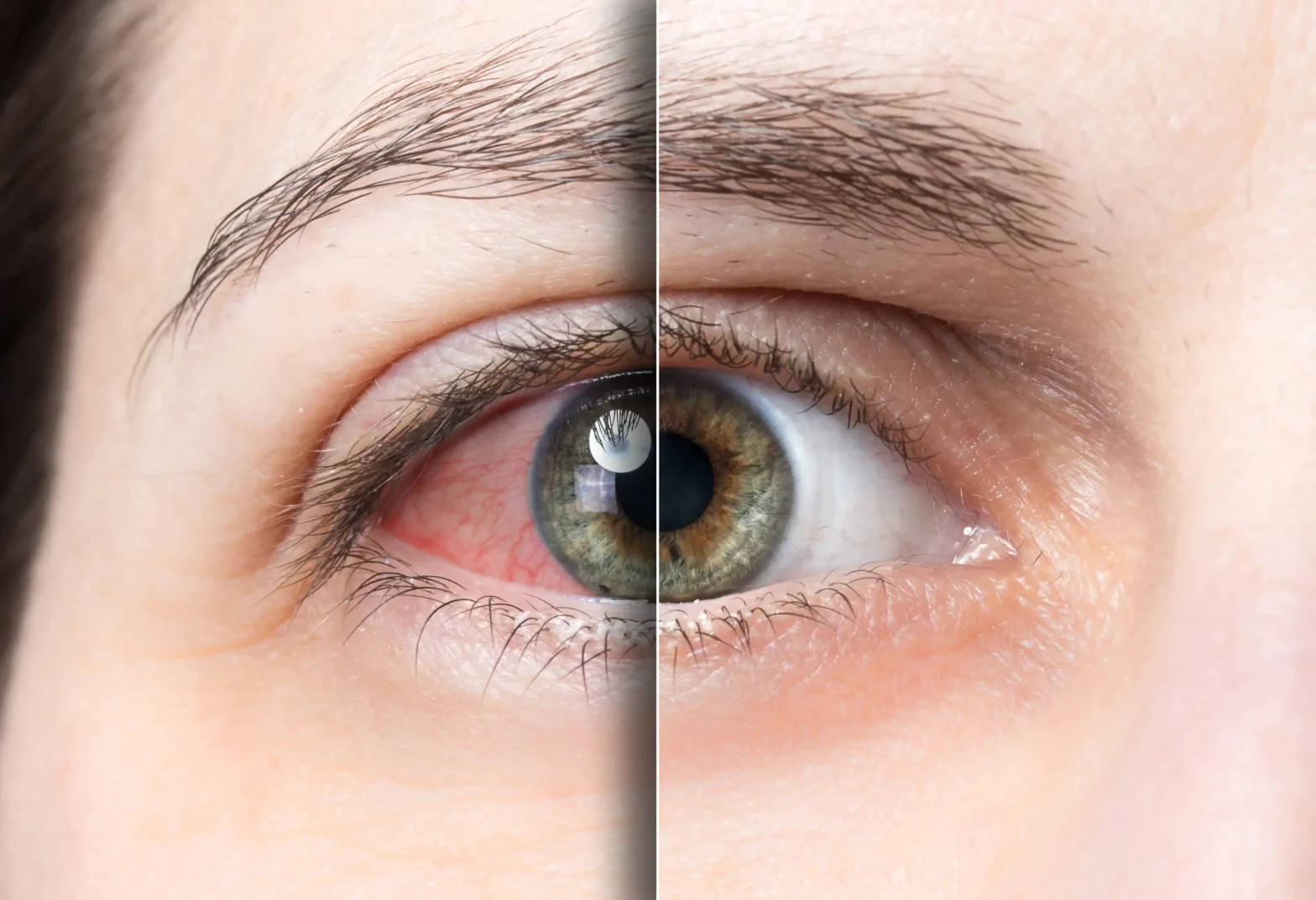 Close up of an eye split down the middle. On the right, a healthy, clear eye. On the left, the eye is bloodshot.