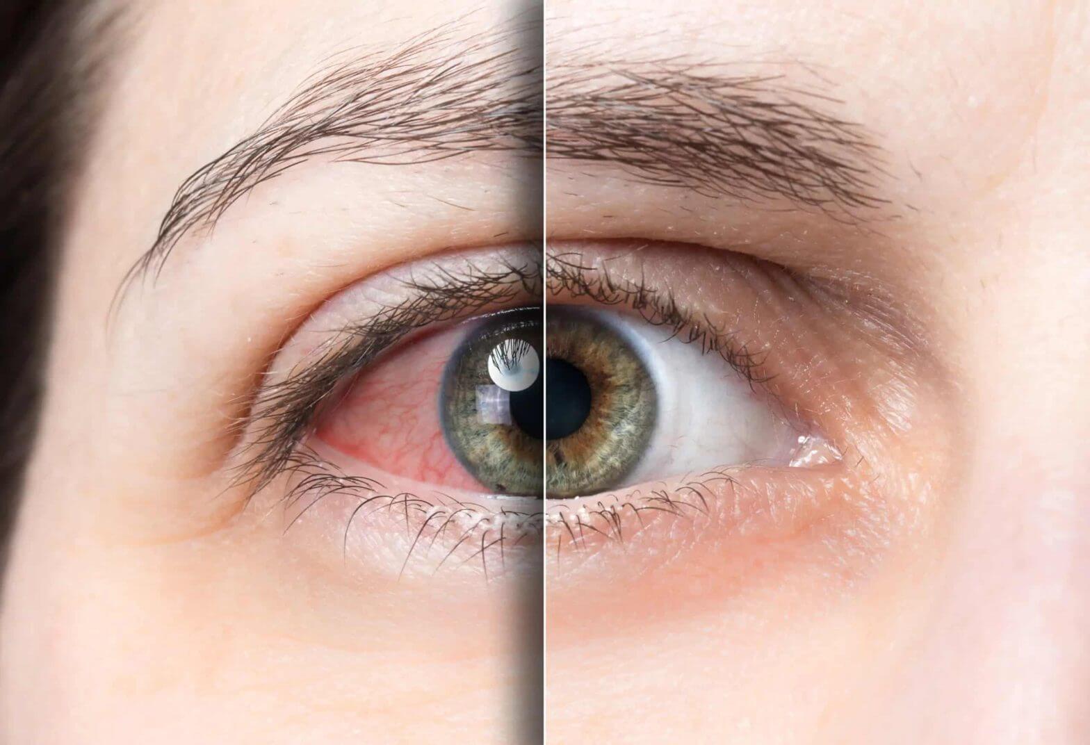 Close up of an eye split down the middle. On the right, a healthy, clear eye. On the left, the eye is bloodshot.