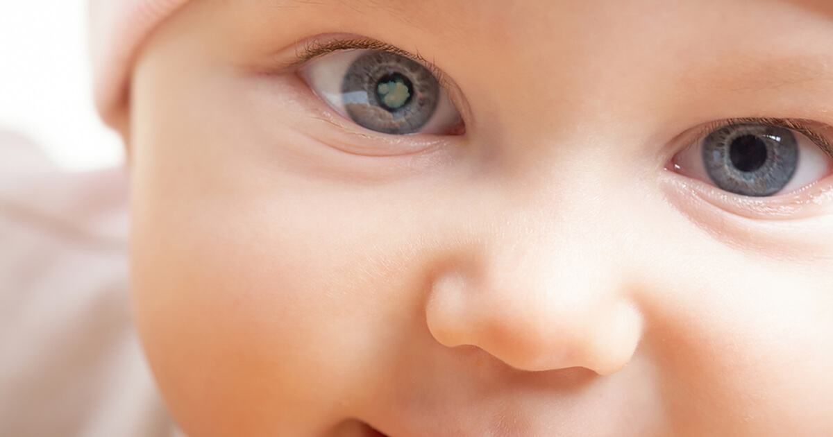 Close up image of infant with an eye showing signs congenital cataract