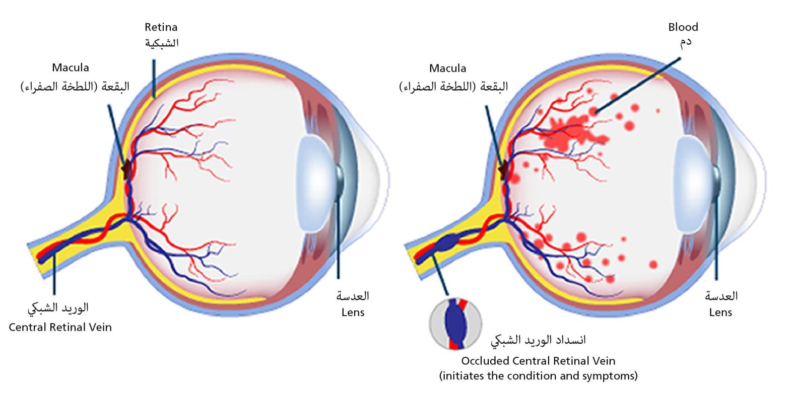 Diagram showing retinal vein occlusion. Labels in English and Arabic.