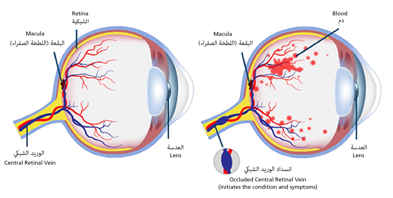 Side-by-side eye diagram showing a healthy retina and one affected by central retinal vein occlusion, with bilingual labels highlighting blood flow disruption.