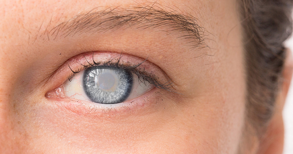 Close up image of childs eyes with one eye showing Cloudy cornea due to cataract.