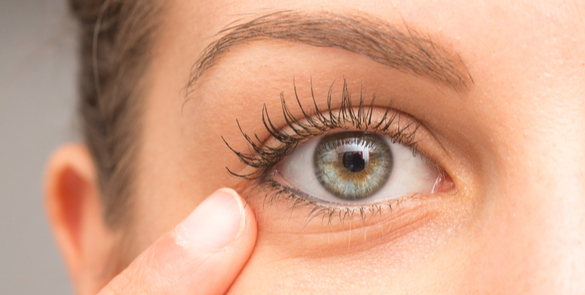 Close-up of a female eye with signs of blepharitis, showing eyelid irritation and redness, treated at Moorfields Eye Hospital Dubai.
