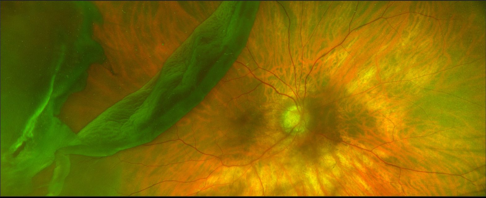 Wide-field retinal scan showing possible signs of retinal detachment and vascular abnormalities