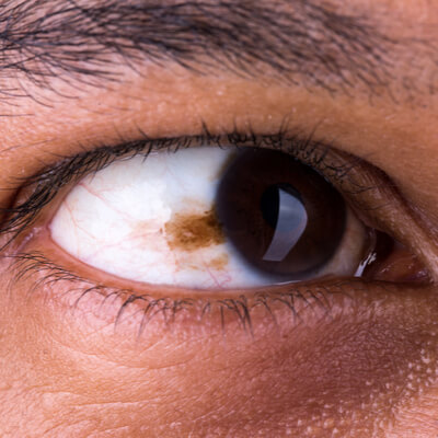 Close-up of an eye with a pigmented conjunctival lesion, potentially indicating a cancerous lesion  or other ocular surface condition