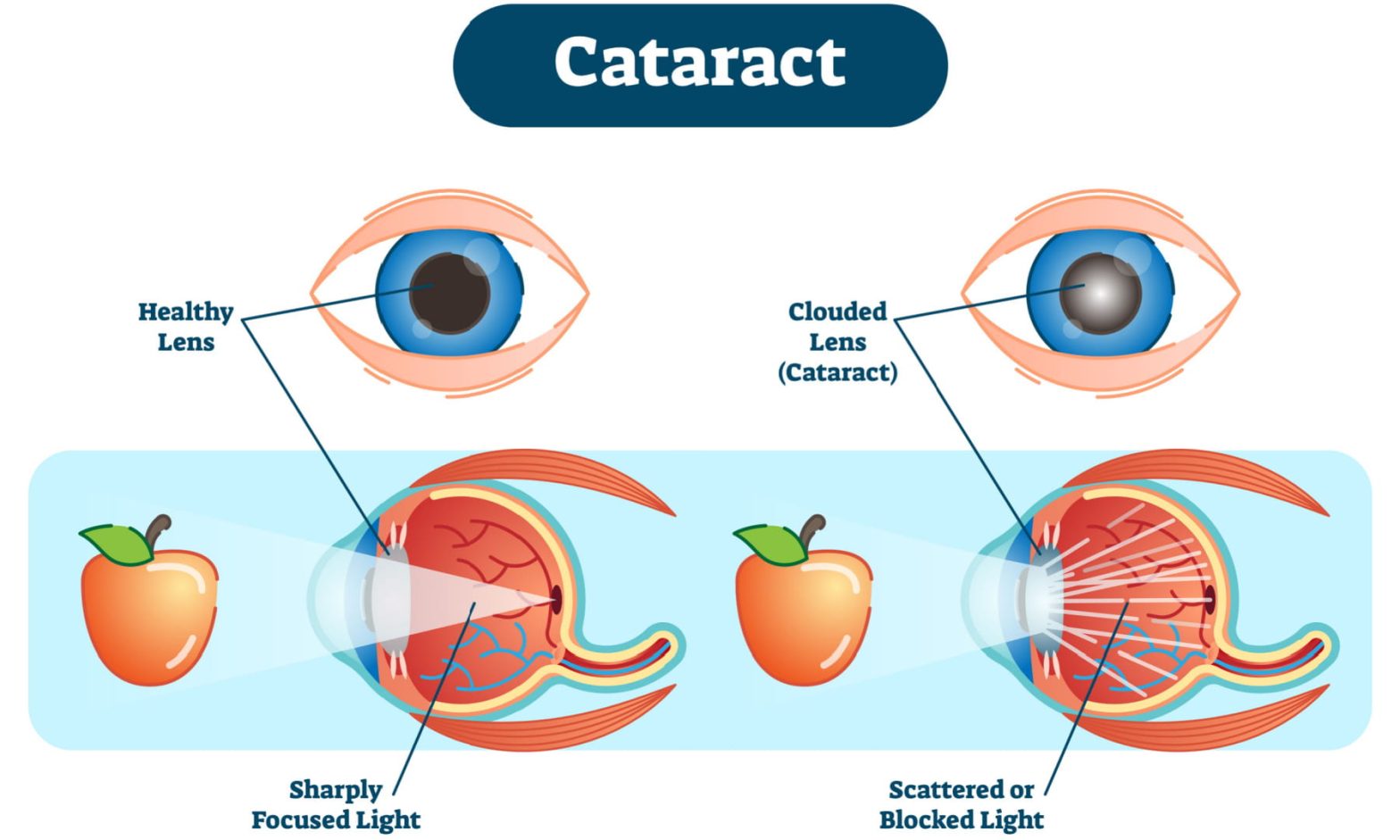 Cataract illustration showing the difference between a healthy lens and a clouded lens