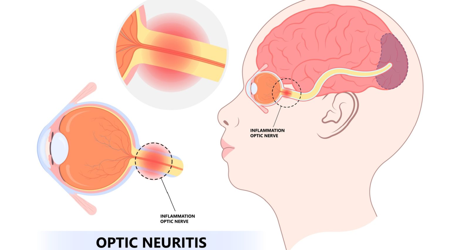 Optic neuritis diagram showing inflammation of the optic nerve and its impact on vision
