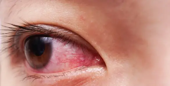 Close up image of an Eye showing redness and irritation, possibly due to conjunctival inflammation or allergy